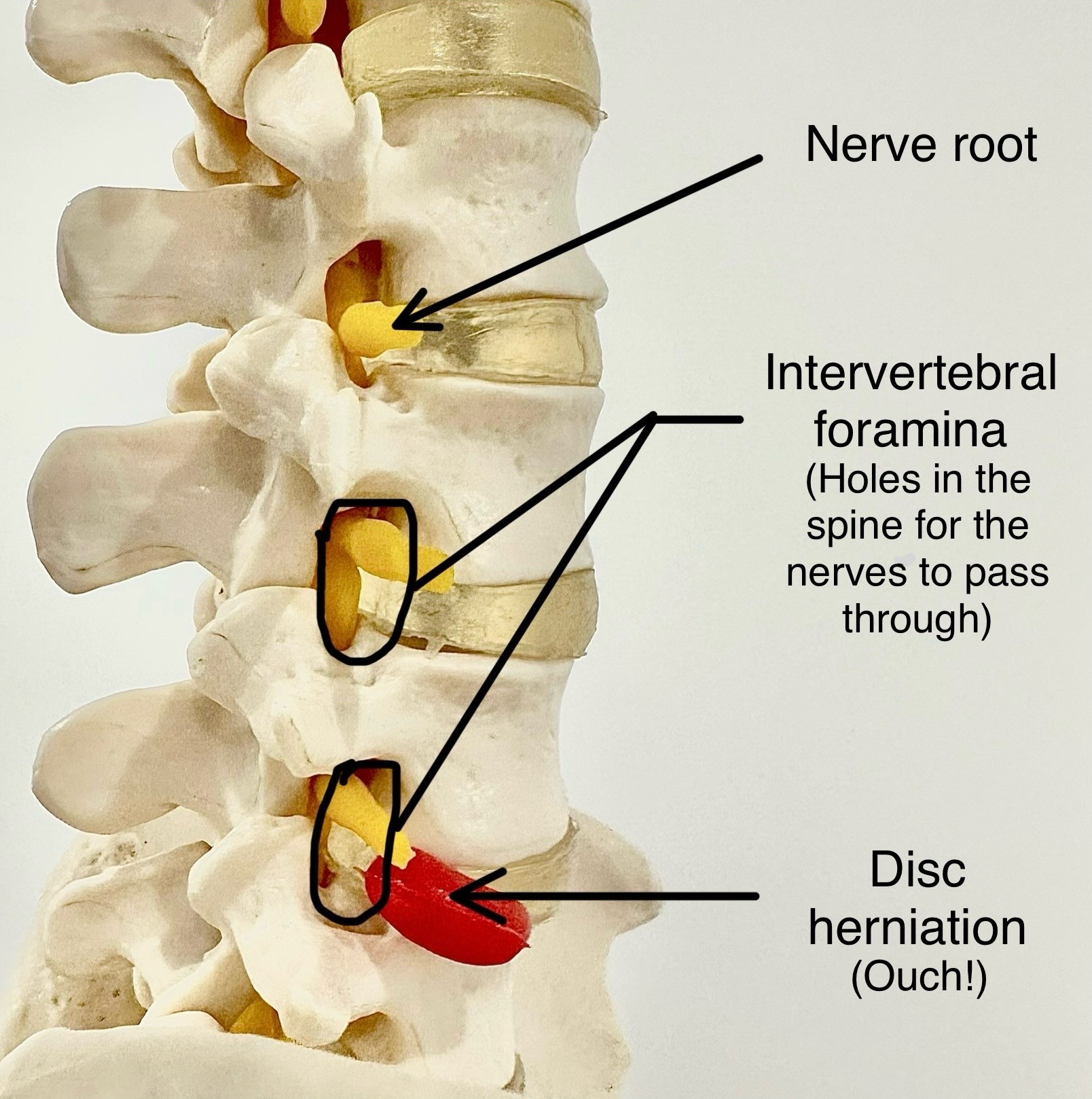 spine-picture-IVF-nerve-roots-disc-bulge spine-picture-IVF-nerve-roots-disc-bulge