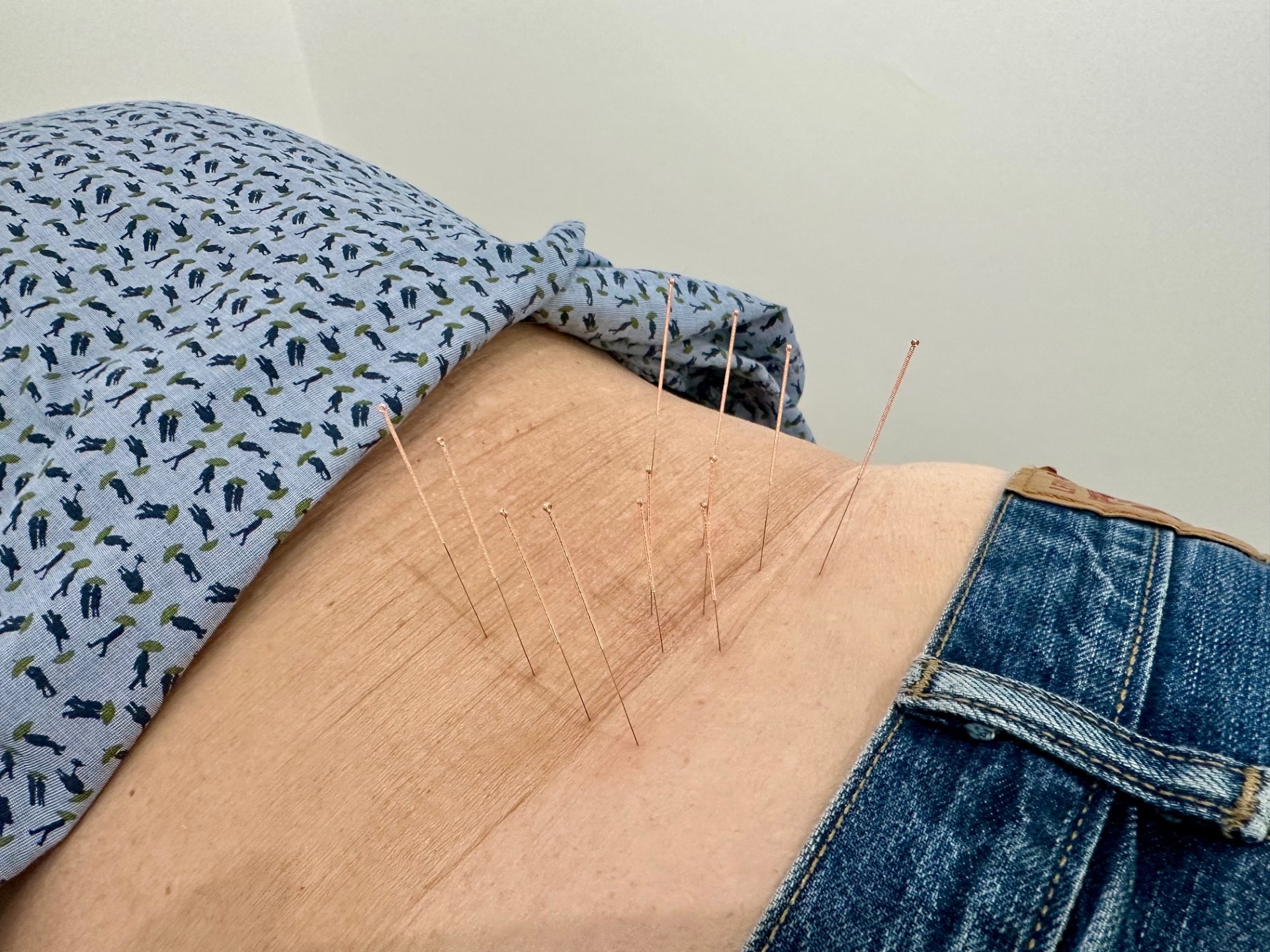 Acupuncture to the lower back York Acupuncture at Acomb Chiropractic clinic. Picture of acupuncture to the lower back, for lower back pain