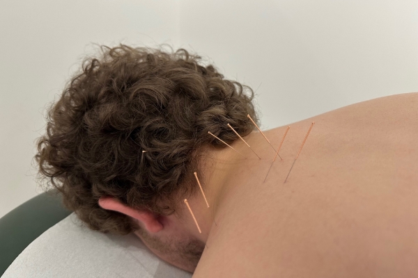 myofascial-dry-needling-and-acupuncture myofascial-dry-needling-and-acupuncture